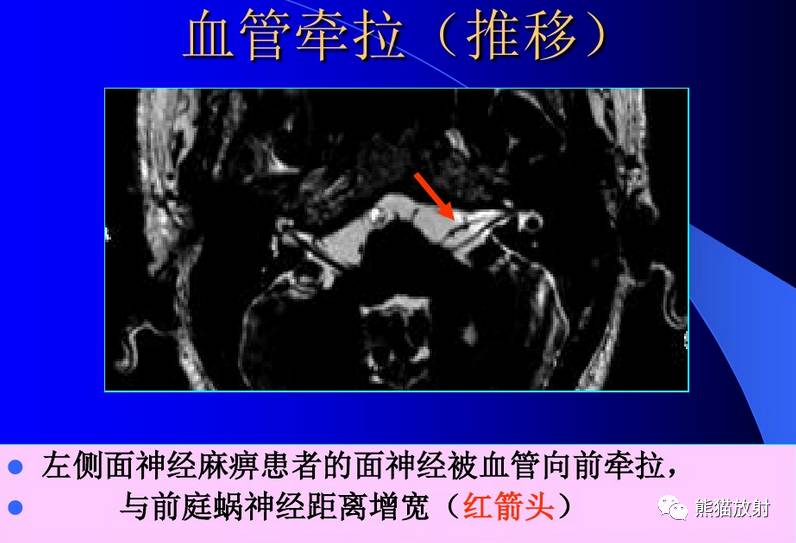 颅神经 mri 断层解剖【收藏】