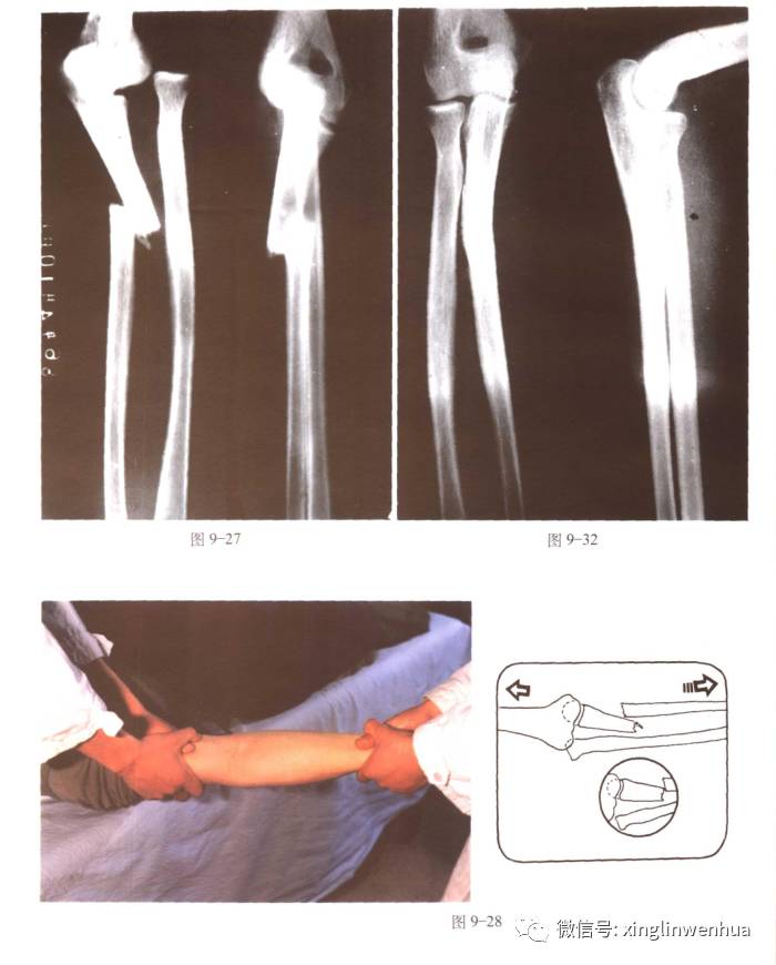 前臂尺骨上1/3骨折合并上尺桡关节脱位