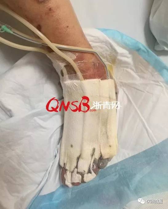 男子右脚发出恶臭连截肢都做不了:只因喜欢扣脚皮