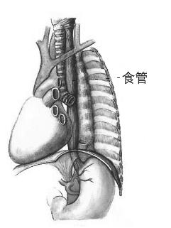 食管癌蛛丝马迹和隔板变化如果有以下表现说明你有可能患此病