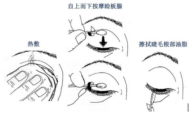 你所知道的干眼症