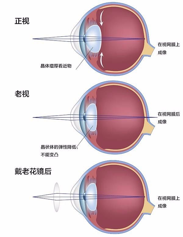 哪些地方老花眼人口多(3)