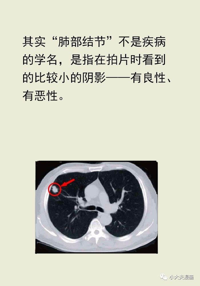 肺部小结节,离肺癌有多远?