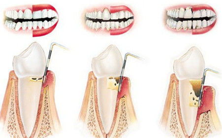 牙痛怎么办止牙痛应急法