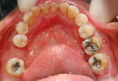 做了根管治疗之后,您的牙齿还能用多久 