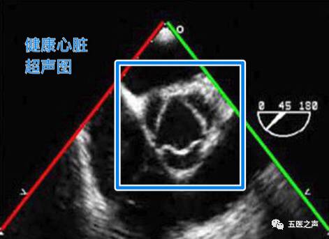 经检查,他被诊断为:二叶式主动脉瓣畸形.