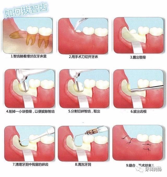 长的很正的智齿拔法 如果是复杂的阻生智齿拔除则需要 切开牙龈,高速