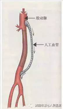 jytv▎医疗县医院血管外科成功开展首例下肢动脉搭桥手术