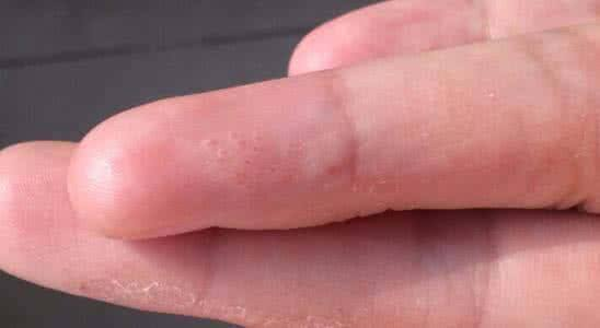 在临床上,手部干燥性湿疹和手癣的症状非常相似,应加以鉴别.