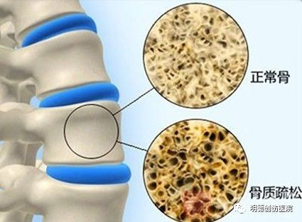 4.老年人治疗骨质疏松症为时已晚.