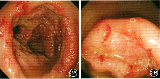结肠镜检查示升结肠及回盲部散在多发溃疡,边缘呈刀刻样改变,周围黏膜
