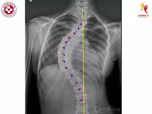 千古谜题之特发性脊柱侧凸的病因