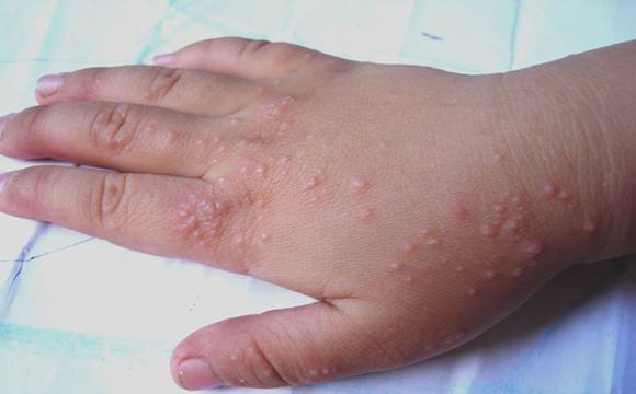 多年的手部湿疹原来可以这样治