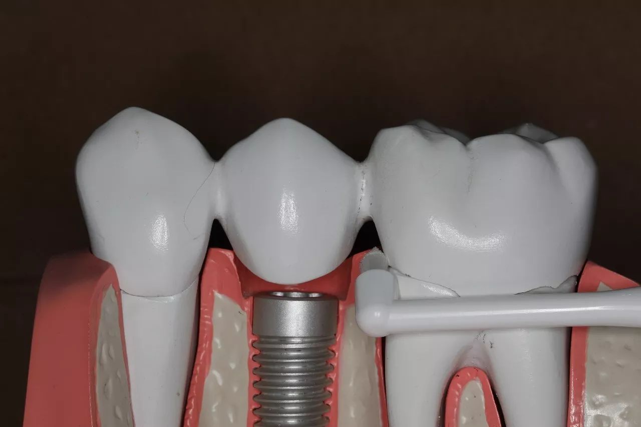 【精彩回顾】无牙颌患者ALL-ON-4（X）种植即刻负重方案 – Ticare Implants
