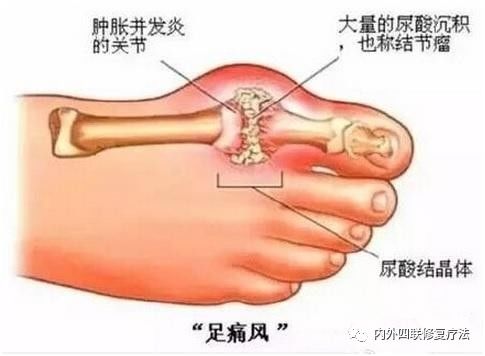 你能承受痛风发作的疼痛吗?