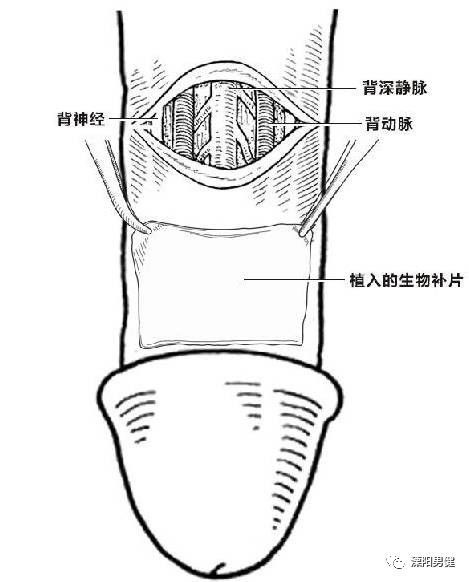 发性早泄患者,只能"一刀切"——切断比常人多的背神经以达到治疗目的