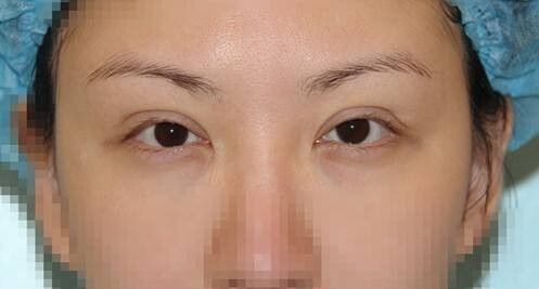 【热门】2022韩国双眼皮修复医生排名更新_名列前五名单公布_双眼皮修复项目价目表奉上