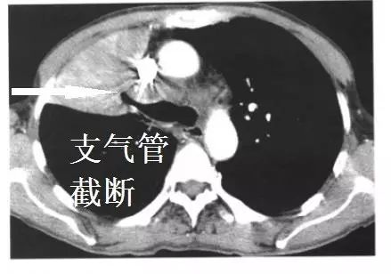 支气管截断征:肿瘤生长,阻断支气管.肺癌.