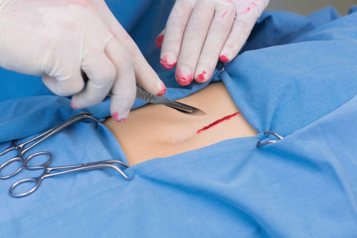 外科手术俗称开刀,凡指透过外科设备或外科仪器,经外科医师或其他