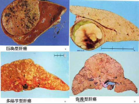 【例题】男性,65岁,肝癌肝叶切除术后第1天,病人感腹痛,心慌,气促,出