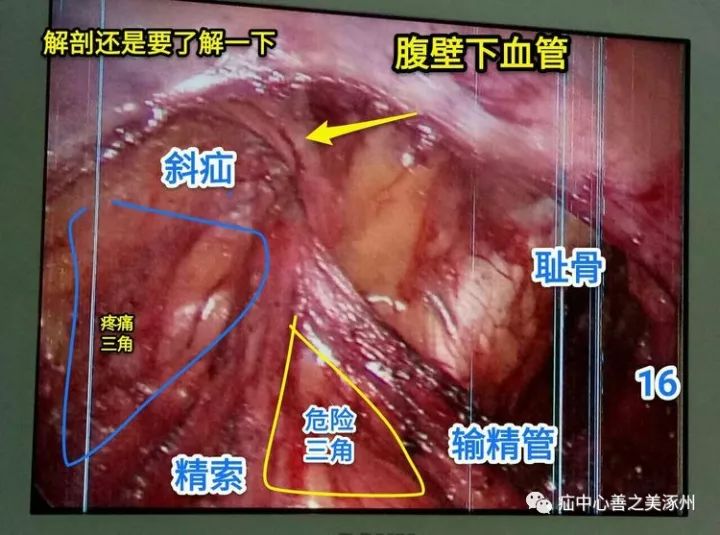 讲述:一个关于疝的故事