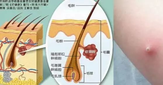 皮肤问题要分清毛囊炎和痤疮带你认识毛囊炎