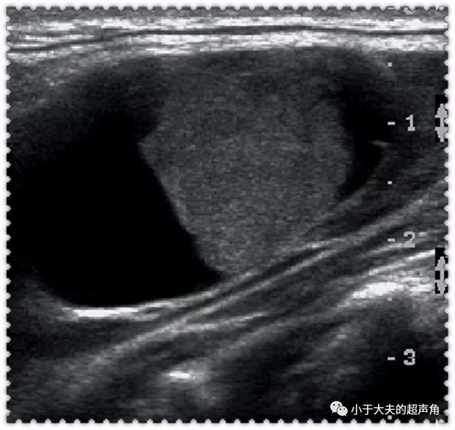 【超声】涎腺乳头状囊腺癌【文献回顾】