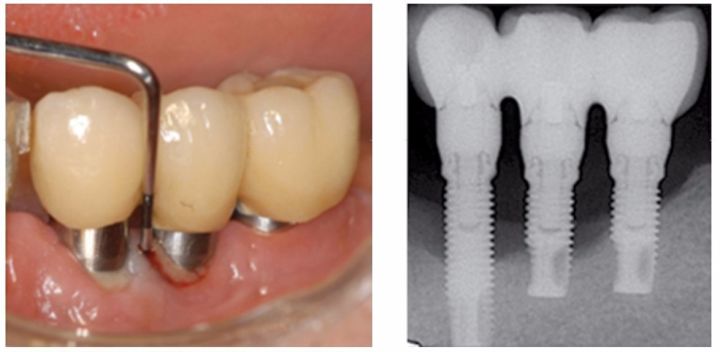 图2种植体周围炎:不仅有局部牙龈红肿,出血,溢脓,而且右侧的x线片上能