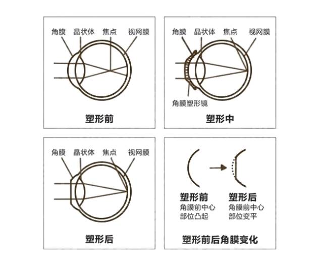 塑形镜的原理_△角膜塑形镜视力矫正原理