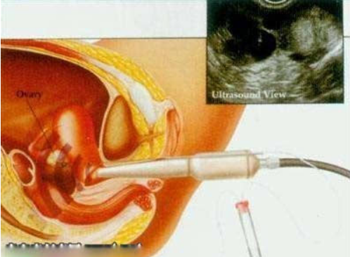 将培育成熟的胚胎植入女性体内,才算是完成人工授精的基本工作. 责任