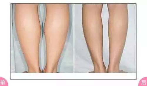 时尚 正文  肌肉型小腿 让腿紧绷起来,一般就可以看到肌肉的形状;脂肪