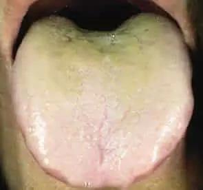 患癌时的舌头是什么样的