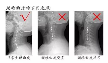 颈椎曲度变直?反弓?