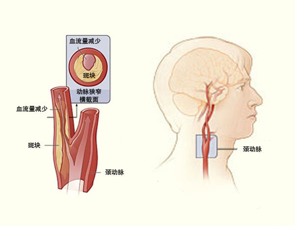 发现颈动脉斑块!可以做"祛斑"手术哦!