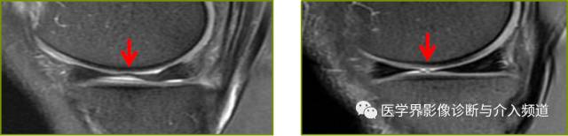 偶尔内侧半月板的中节游离缘可见"变形,明显时称为"裙边样半月板或