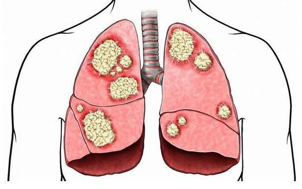 身体出现这4个症状中的任何一个,要警惕肺癌来了