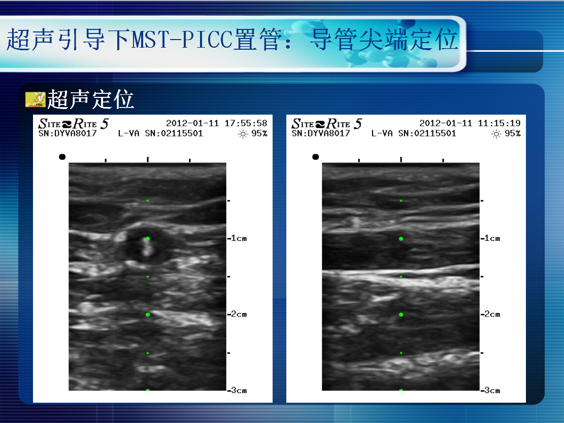 无线超声引导下picc置管