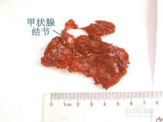 甲状腺结节真的会癌变吗?