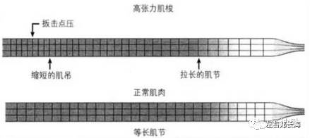 扳机点症状受累肌肉主动,被动拉伸或缩短时受限,运动时可触及明显的