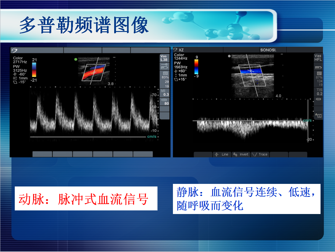 无线超声引导下picc置管