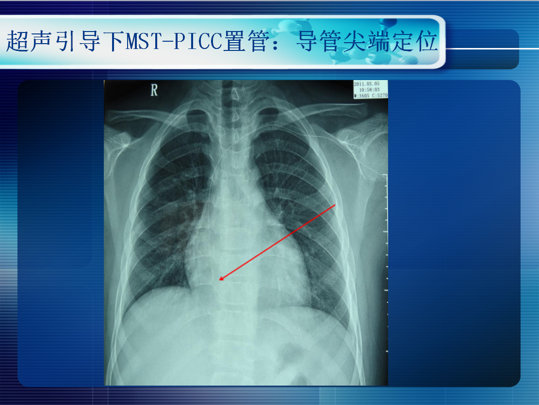 无线超声引导下picc置管