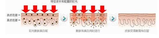 【涨点姿势】光子嫩肤会使皮肤变薄,变敏感,原来是个谣言!