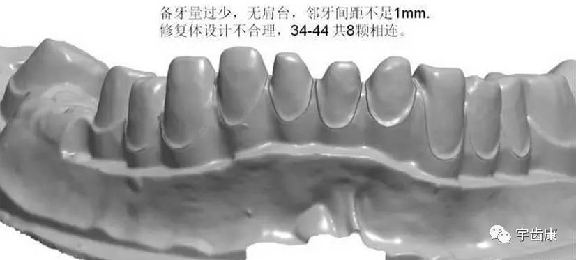 双重边缘线,备牙空间不足,基牙有倒凹或牙桥没有共同就位道,基牙切端