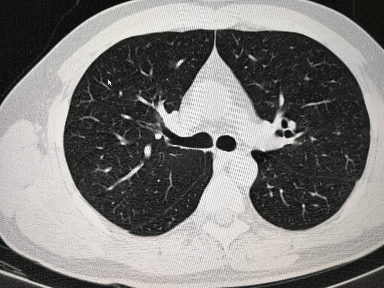 肺癌ct图片症状解析图,正常肺部胸片 正常人 - 伤感说说吧