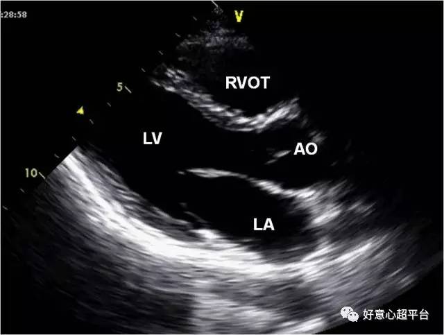 胸骨旁左室长轴切面.la.左心房;lv.左心室;ao.主动脉;rvot.