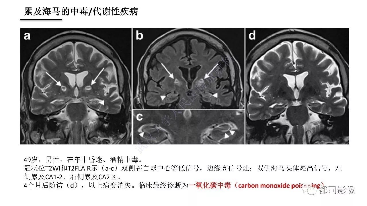 海马正常解剖与疾病影像诊断