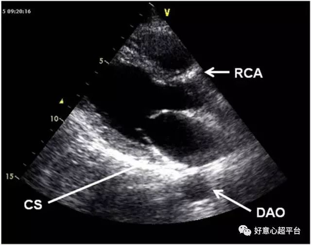 三个容易被忽略的结构:cs.冠状静脉窦;rca.右冠状动脉;dao.