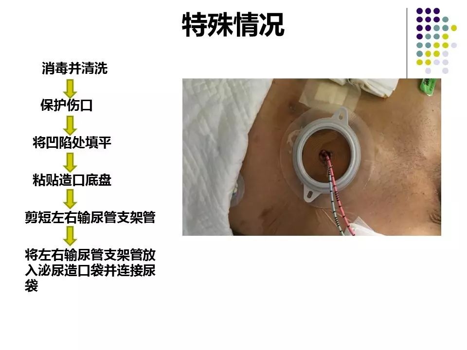 造口患者的护理