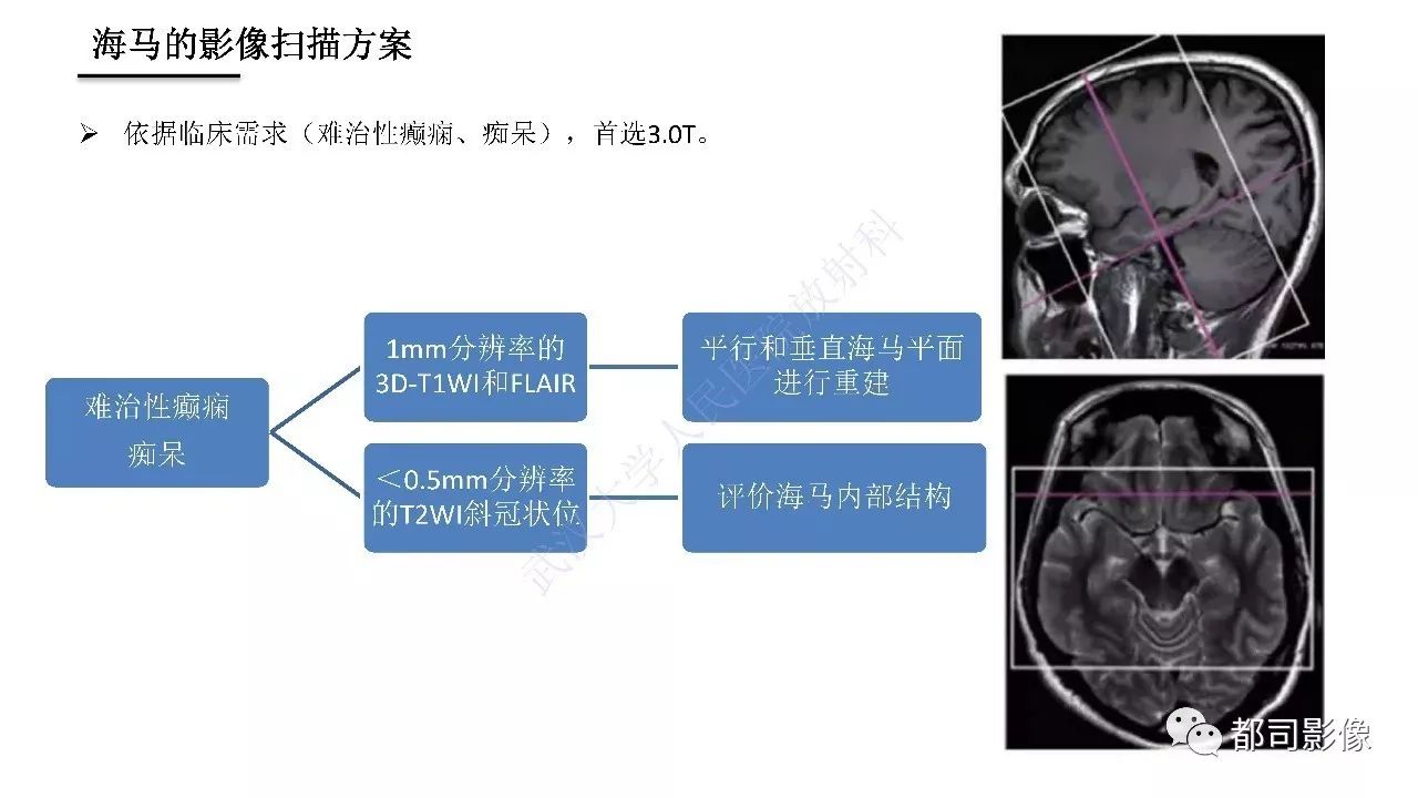 海马正常解剖与疾病影像诊断