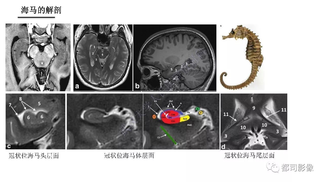 海马正常解剖与疾病影像诊断